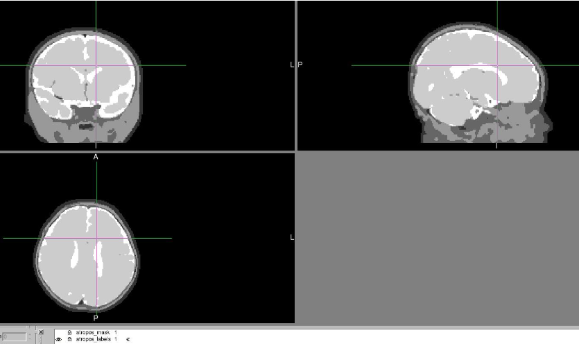 Infant Segmentation